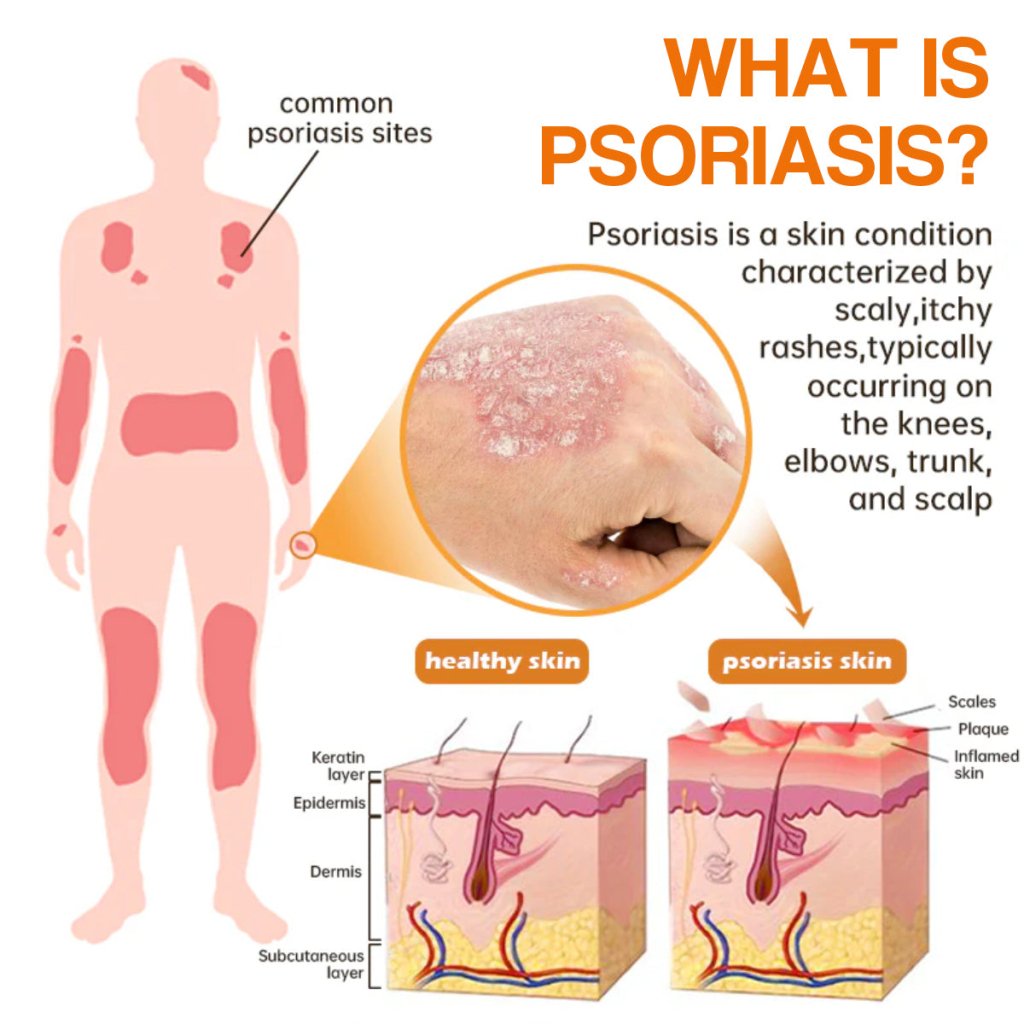 PsoriaHeal Bee Venom Psoriasis Treatment Spray pro
