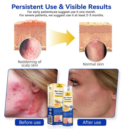 PsoriaHeal Bee Venom Psoriasis Treatment Spray pro